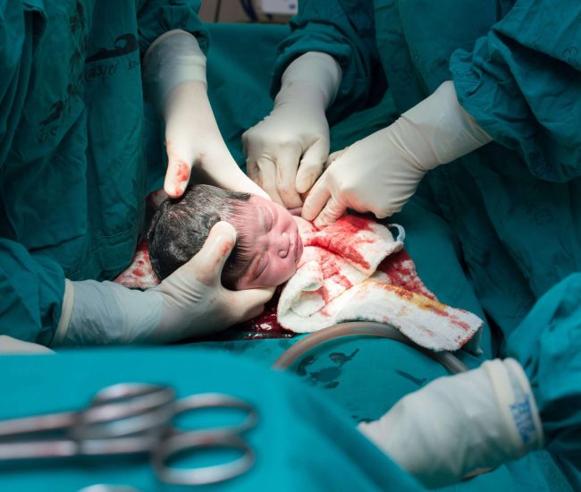 17788596 - classic cesarean section in the operating theater.